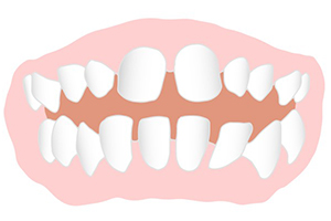 歯と歯の間にすき間がある（すきっ歯・空隙歯列）