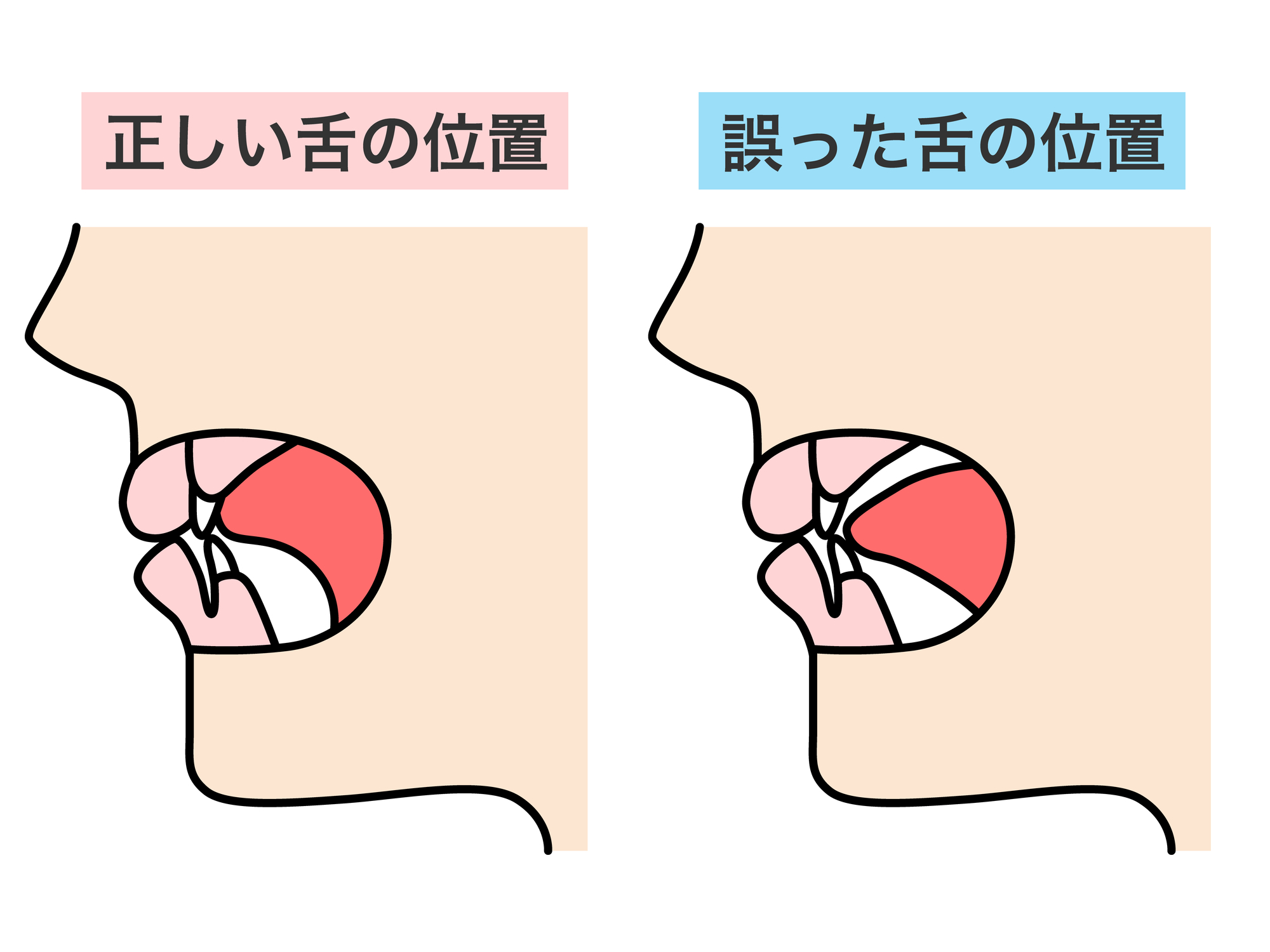 舌の癖にも有効